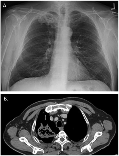 A Chest X Ray Showing A Rounded Mass In Right Upper Lobe B Chest Ct