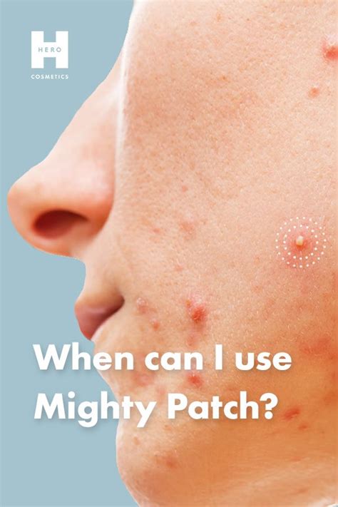 When Can I Use Mighty Patch Pimple Patches Patches Types Of Pimples