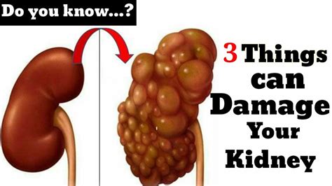 Kidney Diseasedo You Know 3 Things Can Damage Your Kidney Health