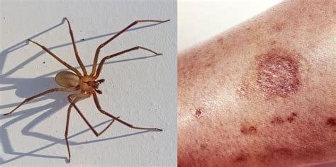 I Survived A Black Widow Bite False Widow Spider Found By Shopper In