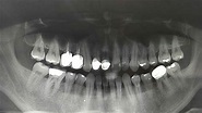 蛀牙可以不理會？牙醫師揭5種後果：最嚴重住院 | 健康 | 三立新聞網 SETN.COM