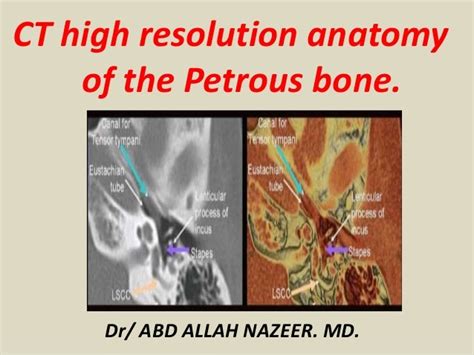 Presentation1pptx Ct High Resolution Anatomy Of The Petrous Bone