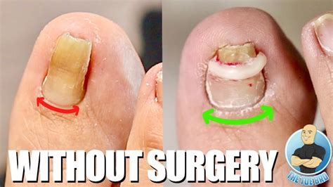 Fixing A Pincer Toenail Without Surgery Severe Ingrown Toenail