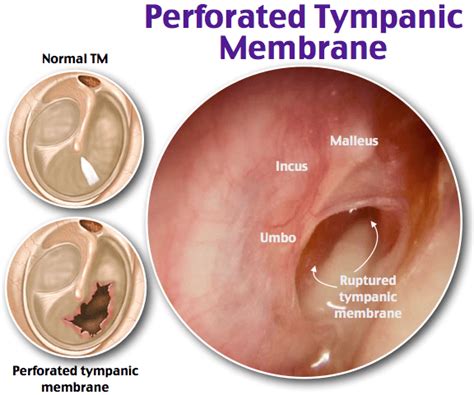 Complete Tympanic Membrane Perforation