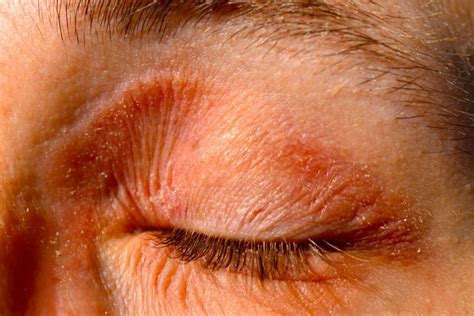 Eyelid Dermatitis Eczema Symptoms Causes And Treatmen