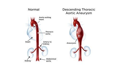 Ascending And Descending Aorta