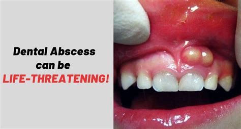 Gum Abscess All About Dental Abscesses Tooth Abscesses And Drainage