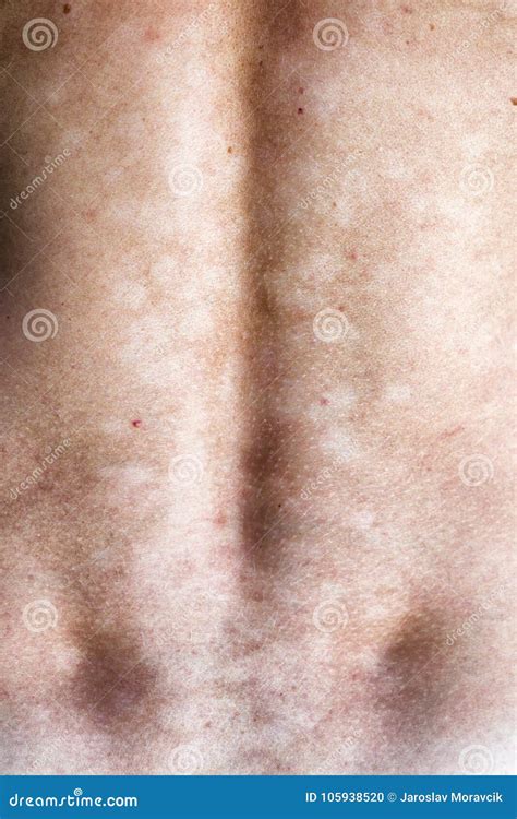 Fungal Infection In The Groin Psoriasis Dermatitis Eczema Stock Image