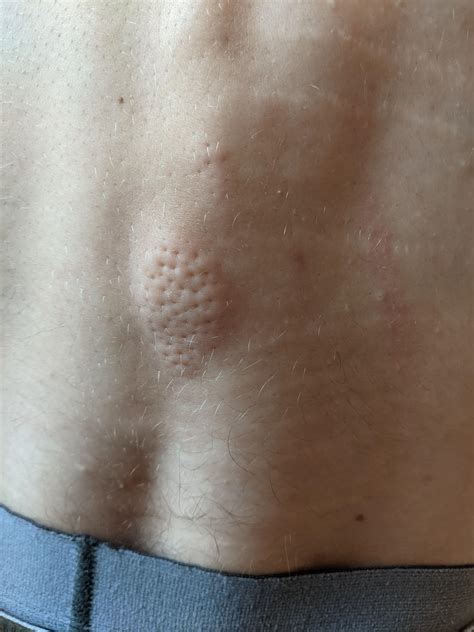 Raised Itchy Spot That Looks Like A Strawberry Rdiagnoseme