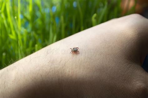 Infected Dangerous Tick On Human Skin A Carrier Of Infections And