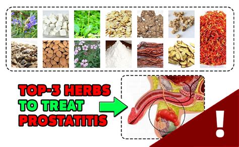 Top 3 Herbs To Treat Prostatitis