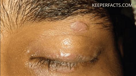 Psoriasis On Eyelids Causes And Prevention Keeperfacts