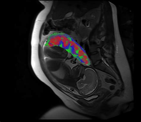 New Mri Method Provides Detailed View Of The Placenta During Pregnancy