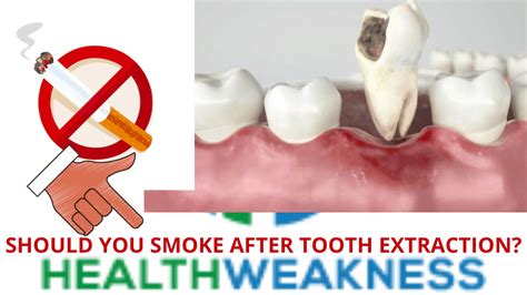 must you smoke after tooth extraction read this first healthweakness