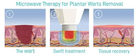 Microwave Therapy For Plantar Warts Clifton Nj Premier Podiatry