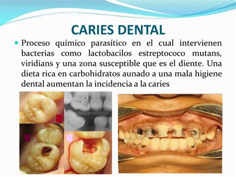 Ppt Cuidados Y Manifestaciones Orales En El Paciente Con Diabetes