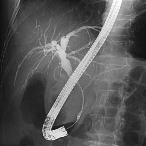 Ercp Showed Severe Stenosis In A Relatively Long Area Of The Middle To