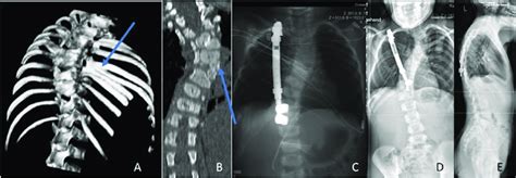 A Female Child With Congenital Scoliosis Combined With Rib Synostosis