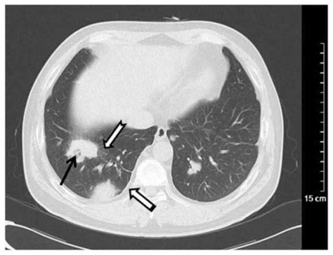 Thoracic Manifestation Of Wegeners Granulomatosis Computed Tomography
