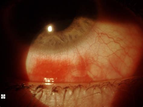 Sonoran Desert Eye Center Hemorrhagic Viral Conjunctivitis