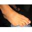 Causes Of A Lost Toe  Almawi Limited The Holistic Clinic