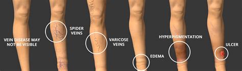 Spider And Varicose Vein Treatments And Removal Medical Vein Clinic