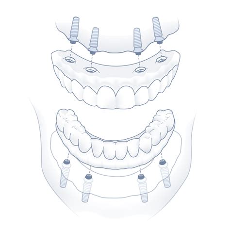 Nuvia Dental Implant Center - Dental Implant Options | Dental implants, Implant dentistry, Dental