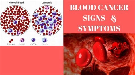 Leukemia marked by an acute destruction of health sustaining red blood cells includes the symptoms of anemia, weakness and extreme fatigue. Blood Cancer Leukimea, Causes, Symptoms, types and ...