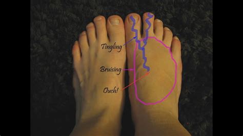 Foot Pain In The Top Of The Arch The Complete Treatment Guide