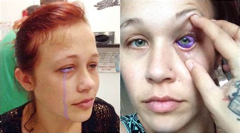 'delhi laser clinic' is the best answer to this question. Model's EYEBALL tattoo goes WRONG! Left crying purple tears | The Indian Express