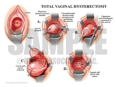 Vaginal Hysterectomy Female Reproductive System Pinterest Surgery Endometriosis And