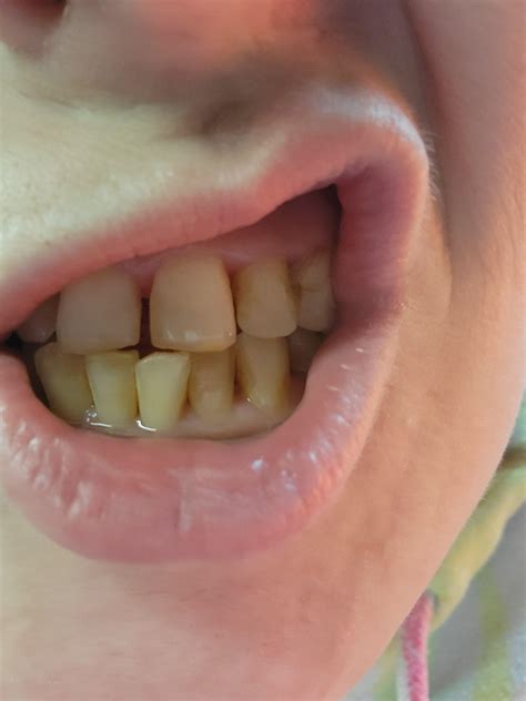 scratched tooth, or messes up bonding? : r/askdentists