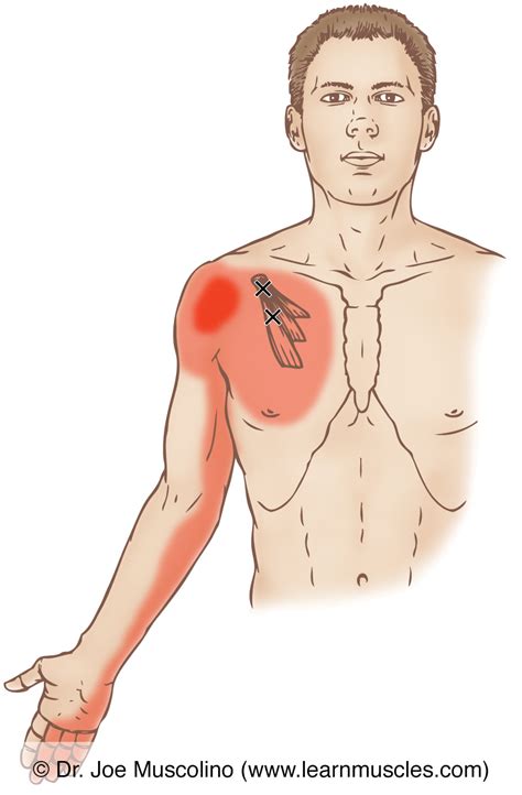 Pectoralis Minor Trigger Points Learn Muscles