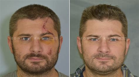 Patient Suffers From Terrible Car Accident Has Unbelievable Face Laceration Repair Results