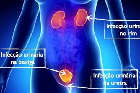 Doenças do Sistema Urinário Check more at https demonstre com doencas do Infecção