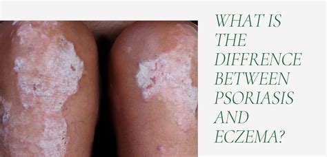 Whats The Difference Between Psoriasis And Eczema