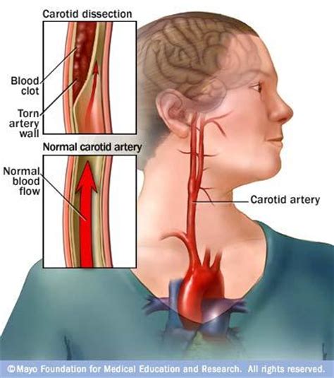 Common carotid arteries travel superiorly in the neck in the carotid sheath in close proximity to the jugular veins, vagus nerve, and recurrent laryngeal nerve. 3313: Chapter 2 - StudyBlue