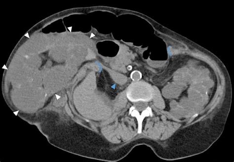 Large Incisional Ventral Hernia Containing A Polycystic Kidney Axial