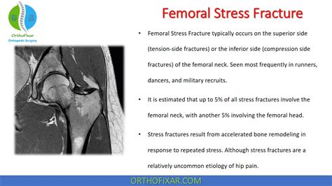 Femoral Stress Fracture Orthofixar 2023