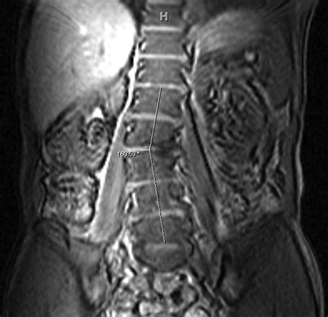 Adult Lumbar Scoliosis Underreported On Lumbar Mr Scans American Journal Of Neuroradiology