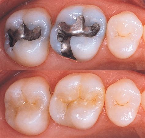 Advanced Dental Tooth Color Fillings Treatment Dentist Clinics Los