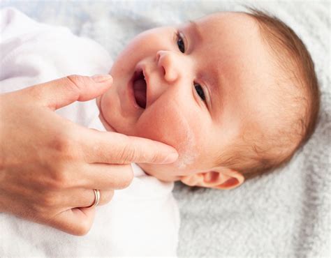 Baby Eczema Vs Baby Acne How To Tell The Difference