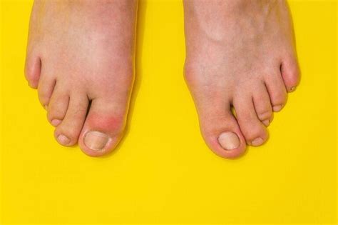 10 Natural Remedies For Gout That Can Spare You From Unnecessary Pain
