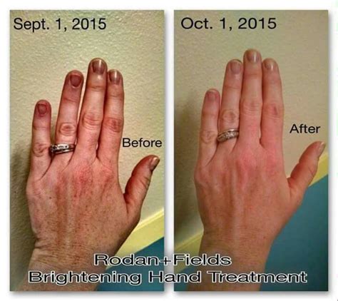 Results In Just 30 Days Can You Believe Get Rid Of Spots Wrinkles