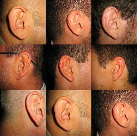 Features Ears 1 Ear Tinnitus Remedies Impacted Ear Wax