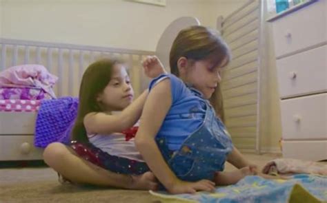 Conjoined Twins Separated At 2 Years Old Defy All The Odds And