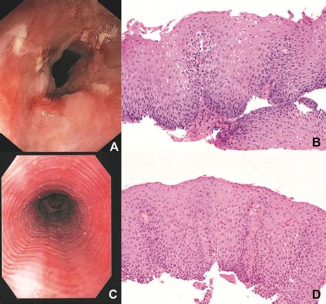 A Endoscopic Appearance Of Ulcerative Esophagitis Secondary To Severe