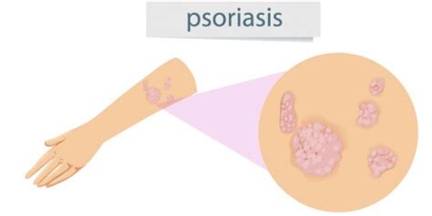 Facts About Psoriatic Arthritis General Center