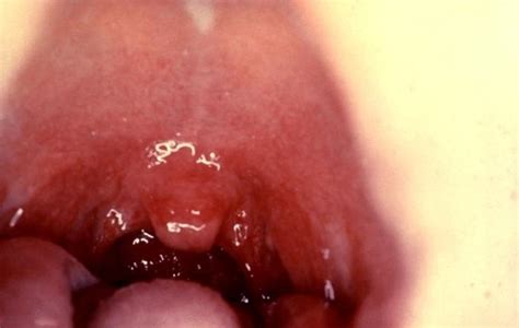 The Signs Of Strep Throat