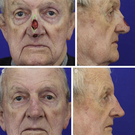 A A Patient With Collapse Of The Nasal Ala And A Scar Extending
